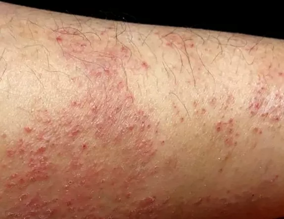 Image #1 from bestienztan