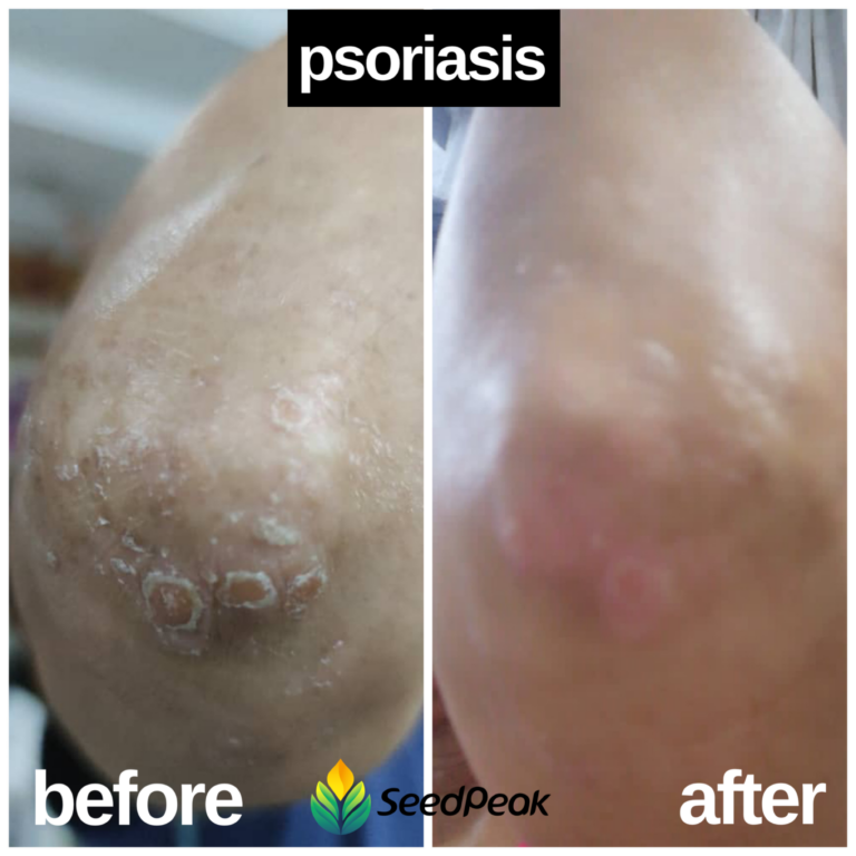 Psoriasis
