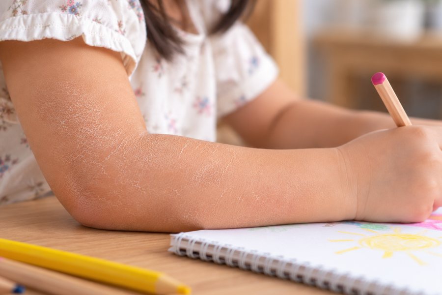 Child drawing, with very dry skin on the forearm