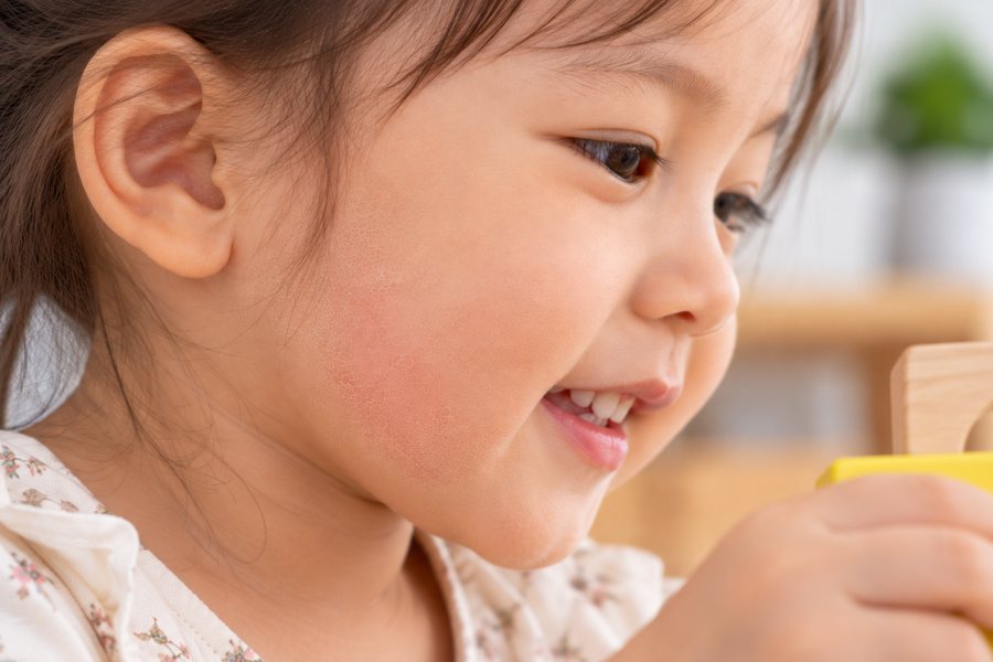 Toddler with a red, irritated cheek
